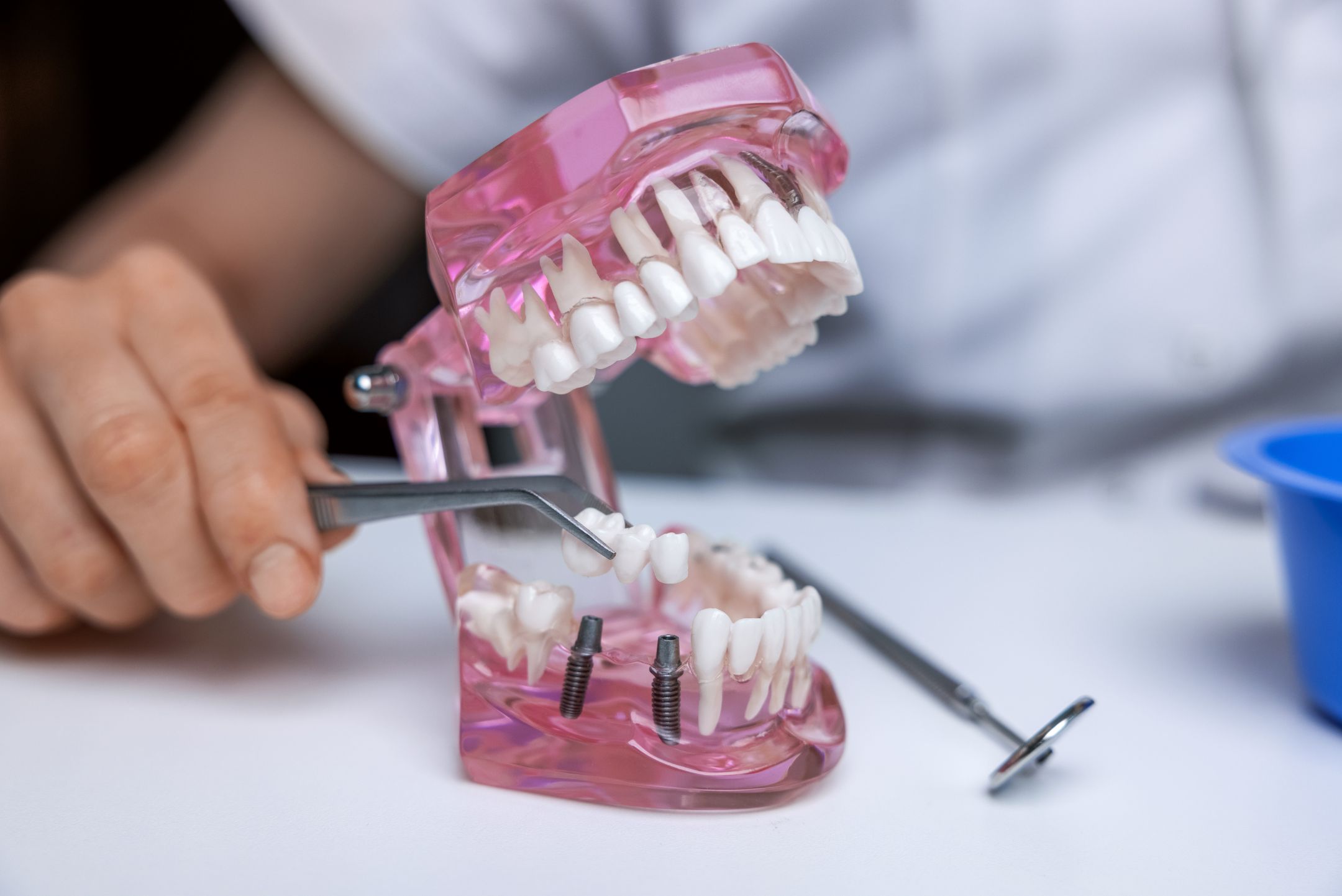 Benefits of Tooth Implants