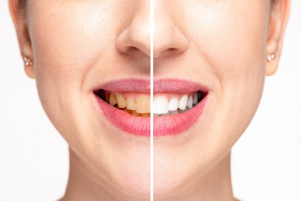 Before and after teeth whitening comparison showing stained teeth and a brighter white smile.